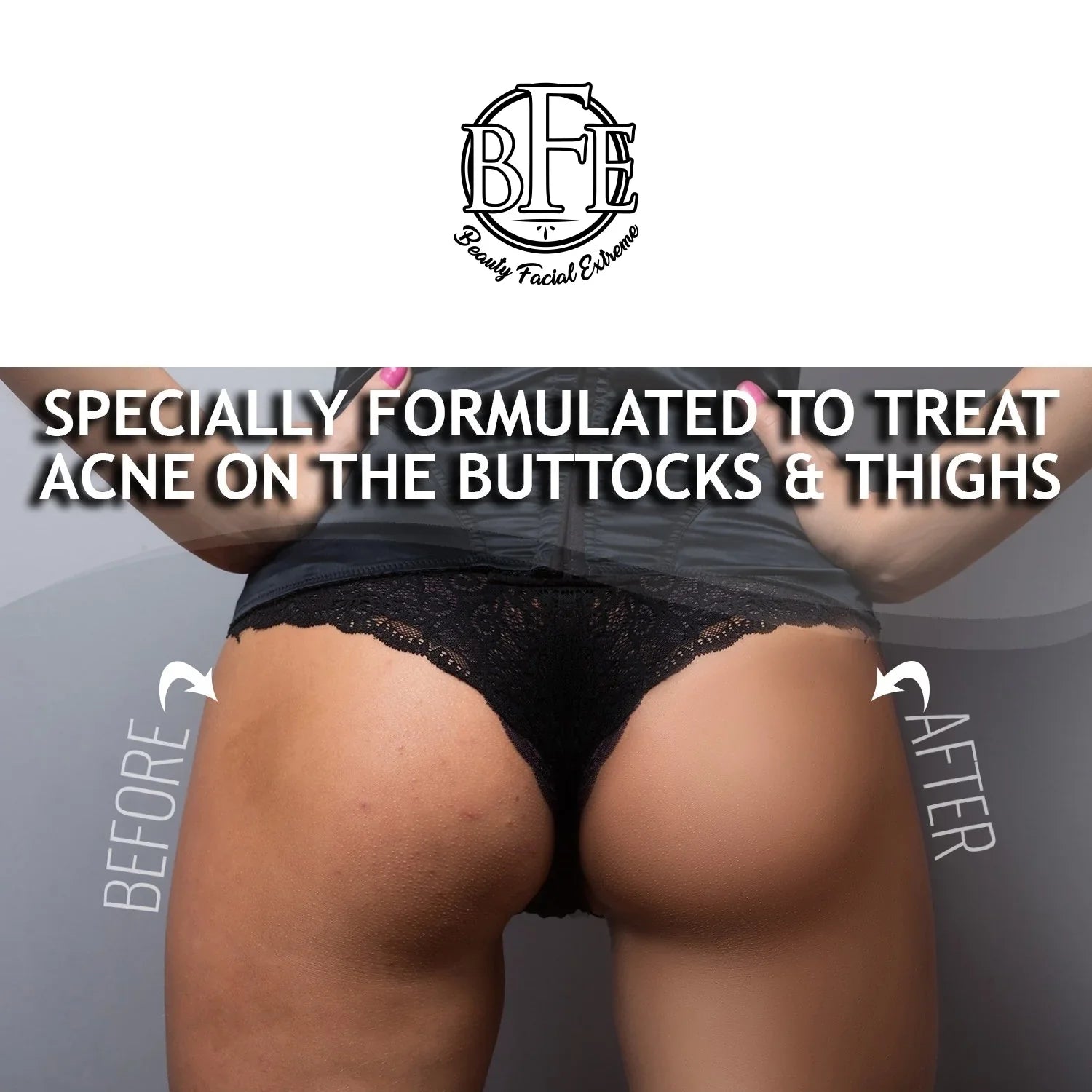 Away Thigh Clears Pimples, Buttocks Thigh and Acne, for and 6.9 Hairs & Area. Future the Anti-Acne Ingrown Treatment- OZ Prevents Buttocks Breakouts.
